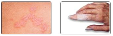 피부 염증(Skin Inflammation) 및 피부 짓무름 (Skin Maceration) 증상의 예
