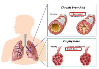 만성 기관지염 (chronic bronchitis)