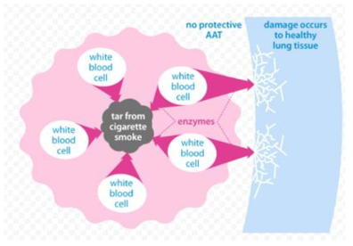 AAT 결핍으로 인한 Emphysema 발생