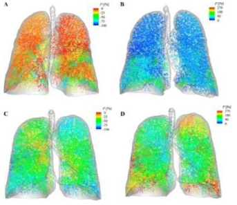 건강한 성인 (A and B)과 천식 환자 (C and D)의 CFD분석을 통한 압력 분포 분석 (참고문헌19)
