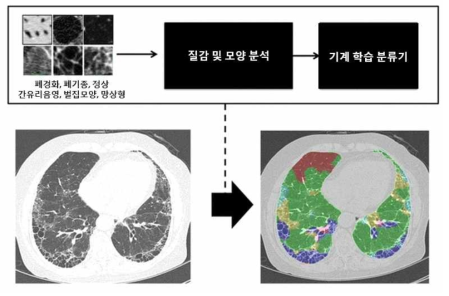 Automated texture-based CT quantification 분석과정