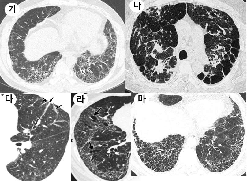 폐 섬유화 영상소견 예시, 가. reticulation, 나. Architectural distortion, 다. Parenchymal band(화살표), 라. Traction bronchiectasis(화살표), 마. Honeycombing