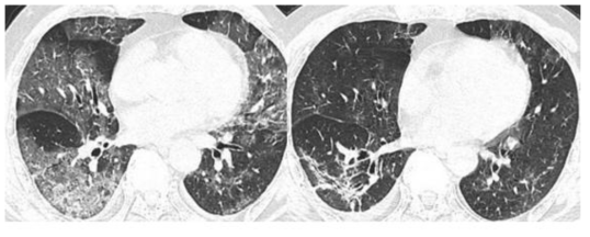 COVID-19 감염으로 입원 3일째 (좌)와 퇴원 후 3일째 (우) 흉부 CT. (좌) 사진에는 전반적인폐의 GGO와 irregular interface margin이 확인되며 (우) 사진에는 대부분의 병변이 호전 된 후 parenchymal band가 남은 것이 확인 됨