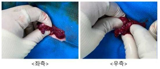 5월 9일 embryo transfer #GB-04, 좌측/우측 난소 상태