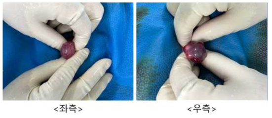 6월 23일 embryo transfer #GH-28, 좌측/우측 난소 상태
