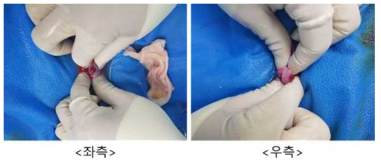 7월 4일 embryo transfer #GC-61, 좌측/우측 난소 상태