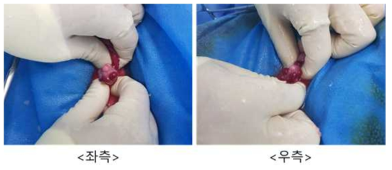 7월 11일 embryo transfer #GD-14, 좌측/우측 난소 상태