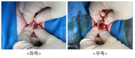 8월 8일 embryo transfer #M12-11, 좌측/우측 난소 상태