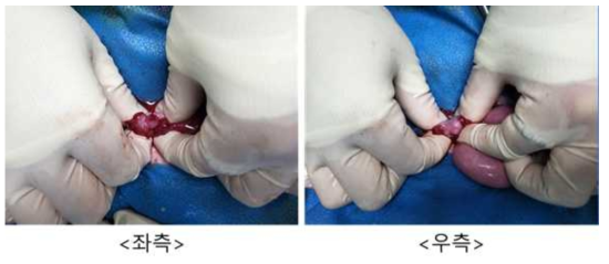9월 2일 embryo transfer #M12-31, 좌측/우측 난소 상태