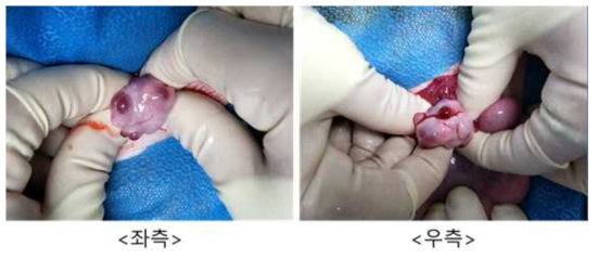9월 8일 embryo transfer #K10-17, 좌측/우측 난소 상태