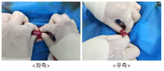 9월 19일 embryo transfer #FL-37, 좌측/우측 난소 상태