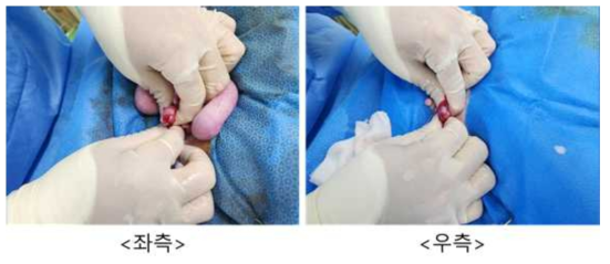 10월 7일 embryo transfer #GB-32, 좌측/우측 난소 상태