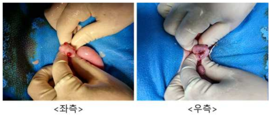 10월 24일 embryo transfer #D11-71, 좌측/우측 난소 상태