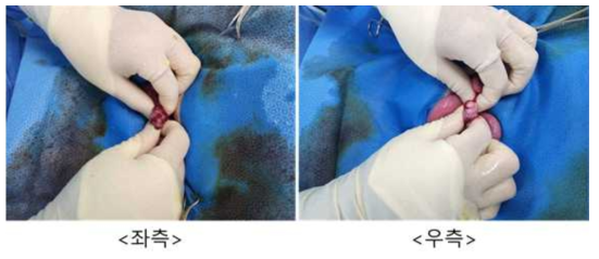 10월 31일 embryo transfer #GB-21, 좌측/우측 난소 상태