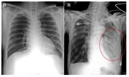 폐 X-ray (좌; 정상인의 폐, 우; 폐렴환자의 폐)