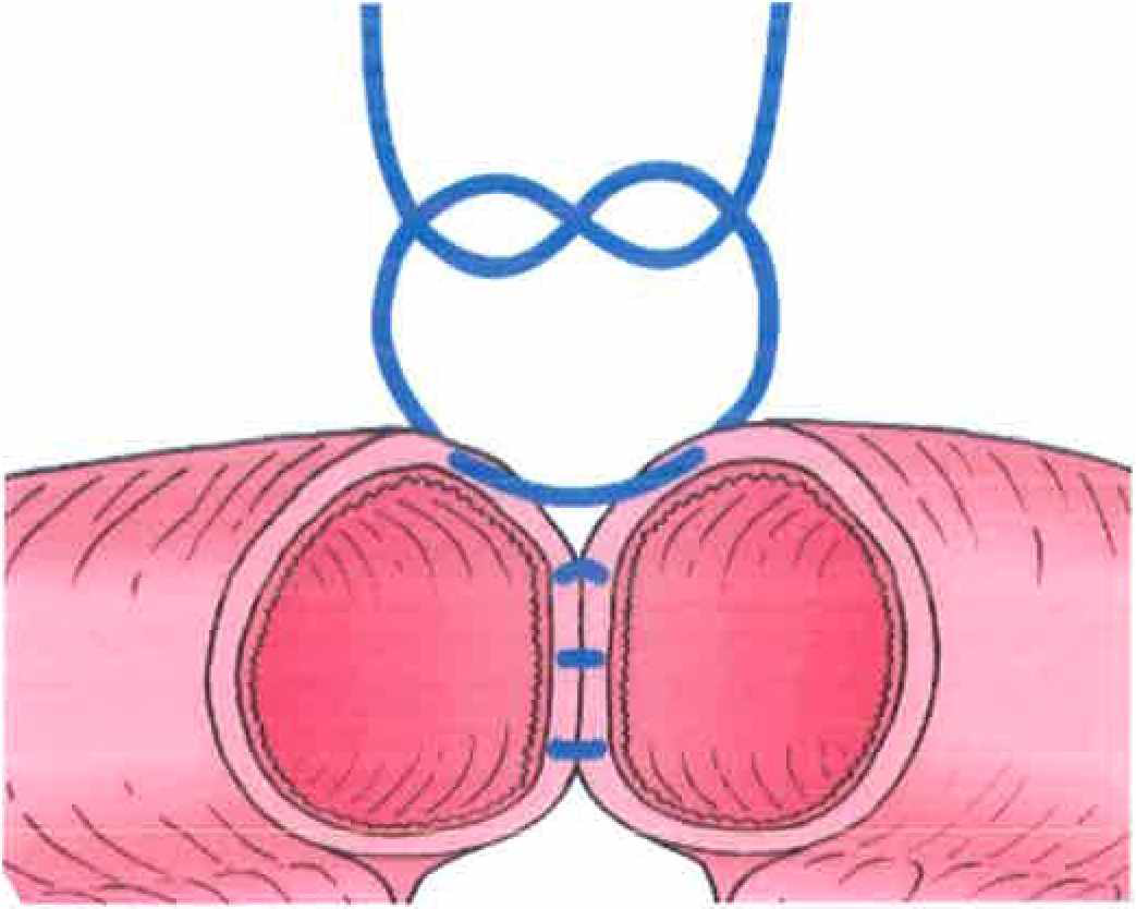 장운동 및 내용물 누출 효과적 방지를 위 한 대장 suture 방법