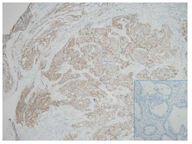 EGFR immunostaining of a gastric cancer patient (left) who demonstrated partial response following GC1118/paclitaxel. Right lower inset, representative photomicrograph of negative EGFR immunostaining