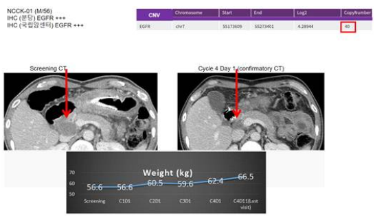 High-level (CN=40) EGFR copy number gain (red box) in a GC-1118/paclitaxel arm participant. His measurable lesion (red arrow) decreased (right pane) compared to baseline (left panel)