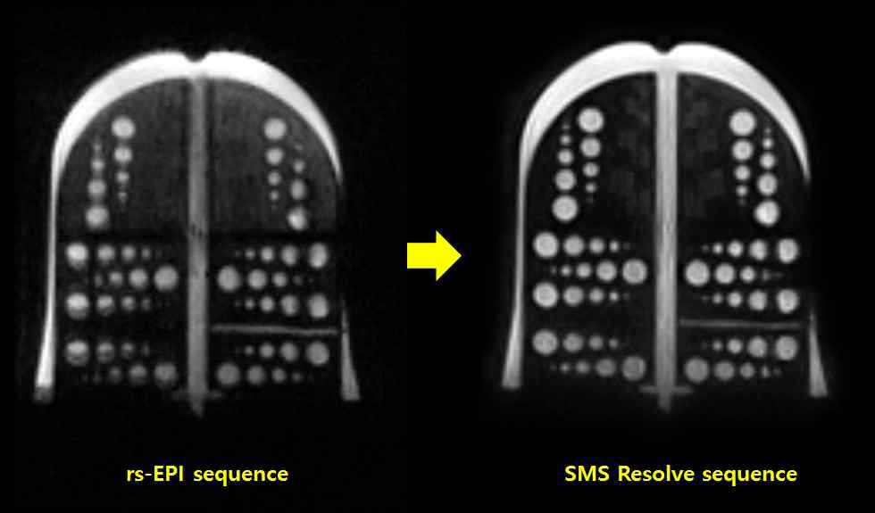 지멘스 Skyra 3T 장비 기존 rs-EPI 시퀀스(좌측)에 비해SMS resolve 시퀀스(우측) 적용 DWI 팬텀영상에서 해상도가 개선됨을 확인함