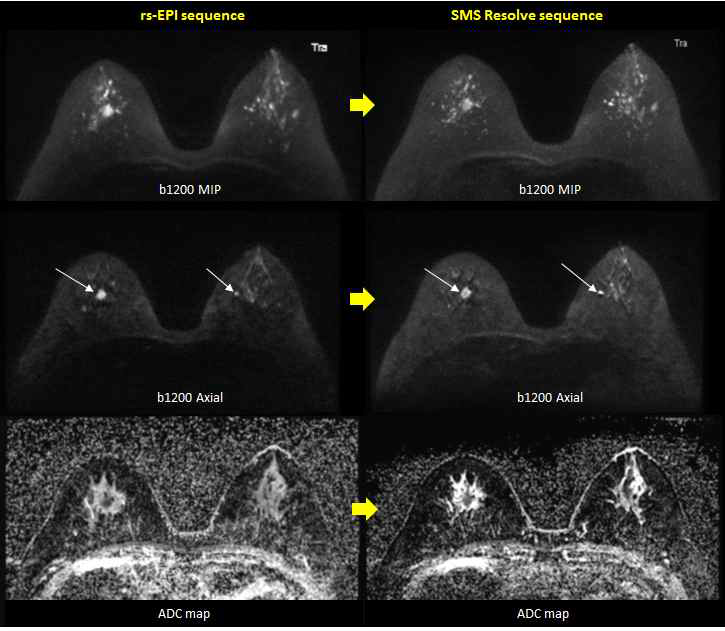 우측 유방암으로 진단된 환자의 DWI 영상. rs-EPI 시퀀스를 적용한 DWI영상(좌측)에 비해 SMS resolve 시퀀스를 적용한 DWI영상(우측)에서 유방암 종괴는 내부가 불균질한 종괴로, 양성 병변은 경계가 분명하고 균일하게 보여 감별진단이 용이함. ADC map에서도 정상 실질은 더 하얗게, 병변은 더 까맣게 보여 대조도가 개선됨