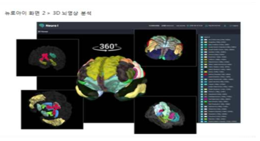 뉴로아이 소프트웨어를 사용한 뇌영상 분석 출처 : 치매예측기술 국책연구단