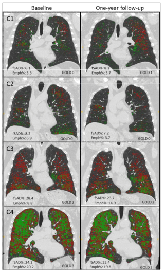 QCT 기반 이전 흡연자 클러스터(C1에서 C4)에서, baseline 및 1년 뒤의 functional small airway disease (fSAD) 및 폐기종(emphysematous) 지역들(Rui et al. 2020, 출간 준비 중). 클러스터마다 1년간 변화 특성이 다름