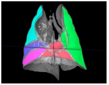 폐엽 영역 분할 3D 영상 (Lobes segmentation). 하늘색(RUL), 파란색(RML), 자주색(RLL), 빨간색(PCL), 녹색(LL)