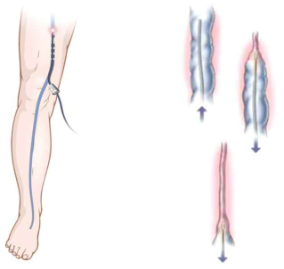 하지정맥류 치료 개념도