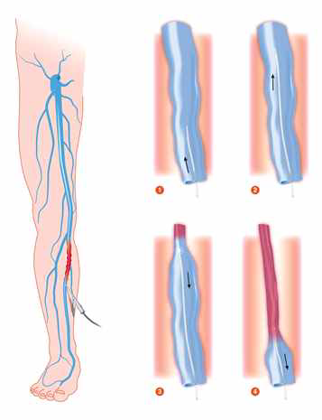 카테터를 이용한 하지정맥류 치료