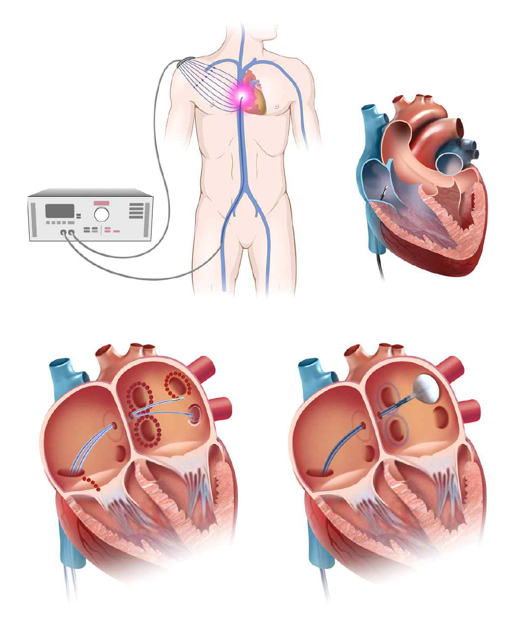 카테터를 사용한 부정맥치료 개념도 (좌) 부정맥치료용전극카테터, (우) 부정맥치료용풍선카테터