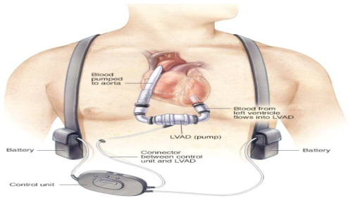 좌심실 보조장치 (Left Ventricular Assist Device, LVAD)