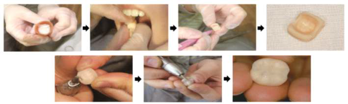 치과진료실에서 임시 치관 제작의 예시 출처: GC unifast Ⅲ 사용 후기
