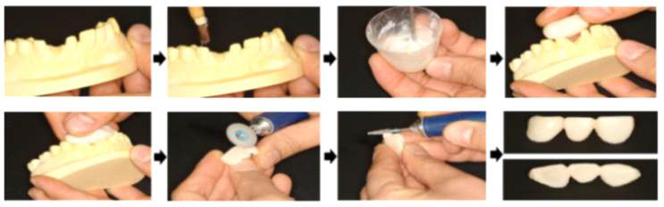 치과기공소에서 간접법을 이용한 임시 치관 제작의 예시 출처: Denfoline 2010.02.02 기사