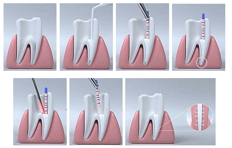 치근관 충전재와 치근관 전색재를 이용한 근관충전의 예시