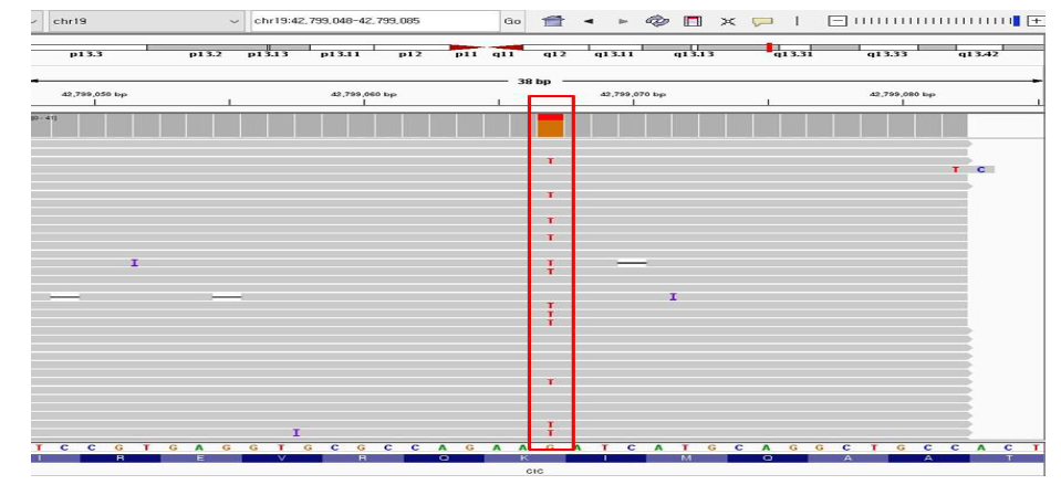 MDS 검체의 NF1