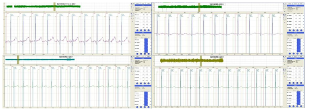 원격측정장치 삽입 수술 후 심전도 파형