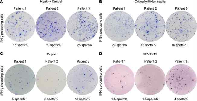 COVID-19 환자에서 IFN-g 생성 저하 (Ramy et al. JCI Insight, 2020)