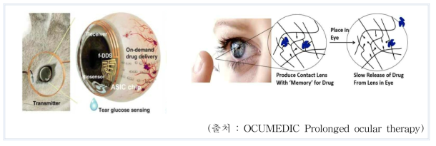 당뇨망막질환용 약물방출 콘택트렌즈(좌), OcuMedic사의 항염증 약물방출 콘택트렌즈(우)