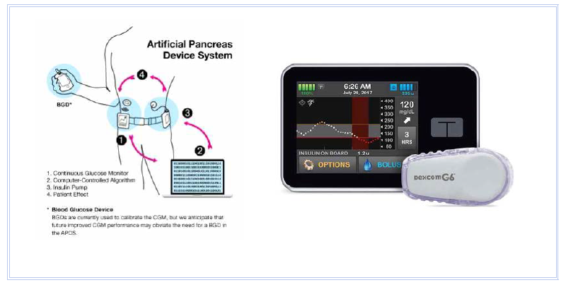 웨어러블 자동주사 시스템 구동 방식 및 사례 (Tandem Diabetes Care)
