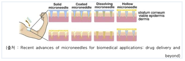 마이크로니들 형태 종류
