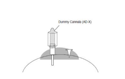 Guide cannula 보존을 위한 dummy cannula 설치 예시