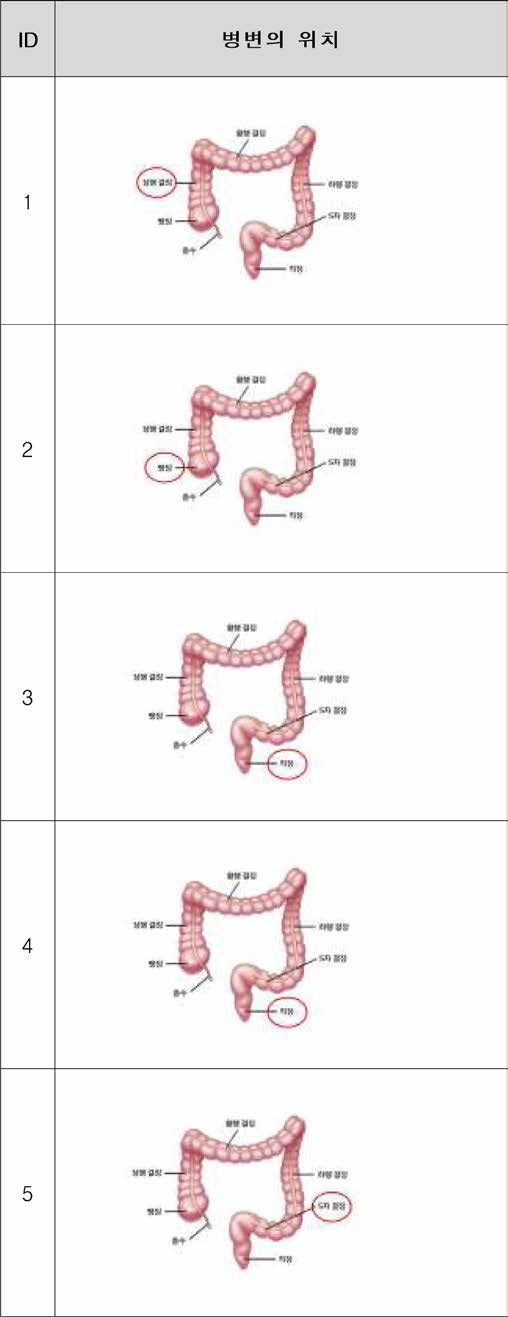 확보한 대장암 종양 조직의 병변 위치