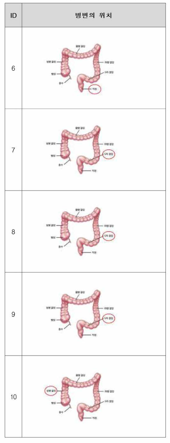 확보한 대장암 종양 조직의 병변 위치 (연속)
