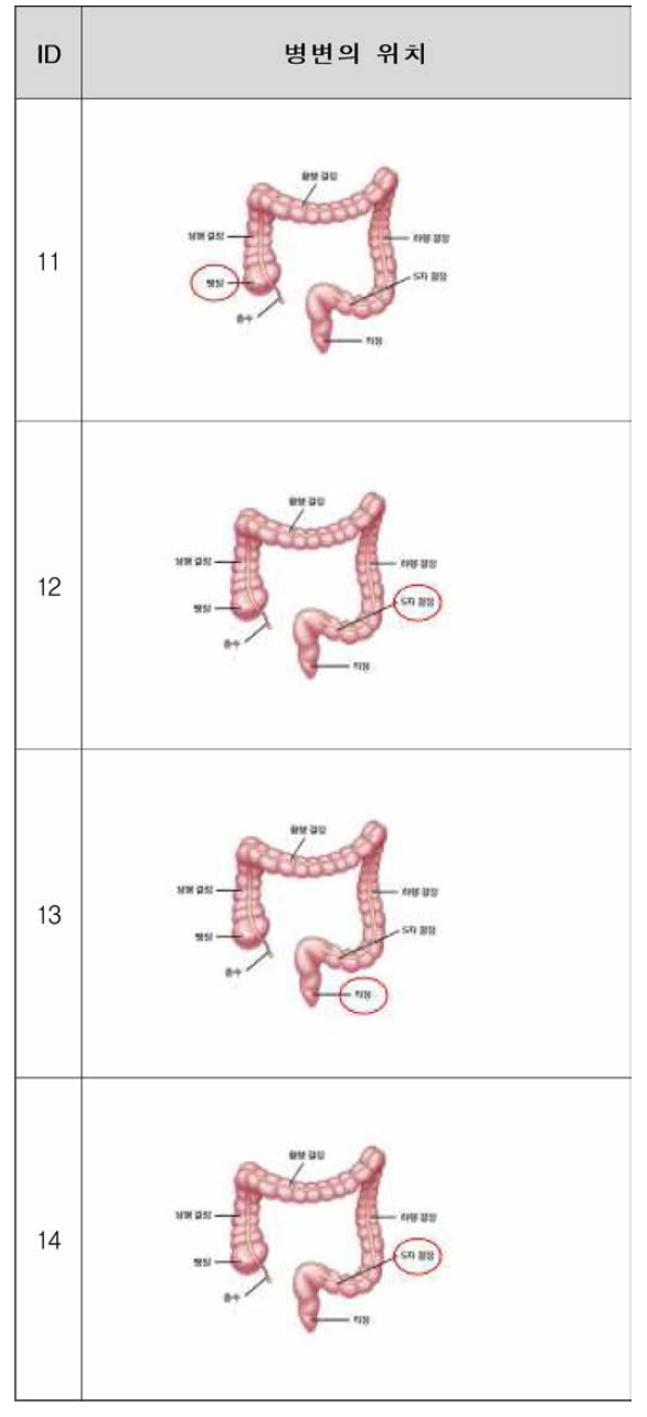 확보한 대장암 종양 조직의 병변 위치 (연속)