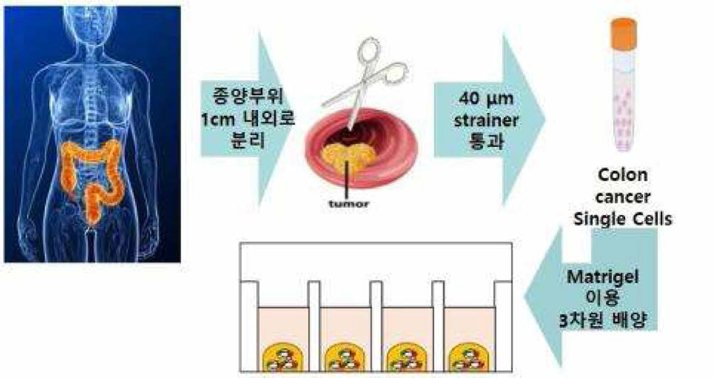 환자 유래 대장암 오가노이드 확립 방법