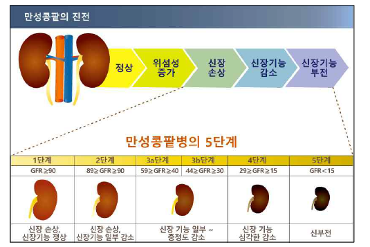 만성 콩팥병의 5단계