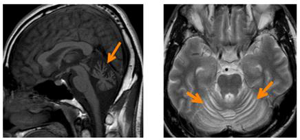 소뇌실조증 환자의 소뇌 MRI