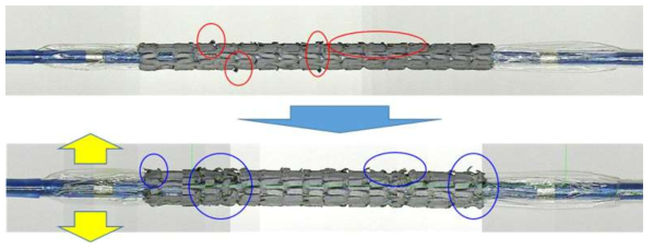 원통형 스텐트에 무기층(ZnO/Zn/Mg)을 형성한 후 풍선 카테터에 크림필 시킨 모습(위)과 추가적으로 확장시킨 모습(아래)