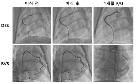 스텐트 삽입 후 1개월 Follow-up QCA 분석 진행