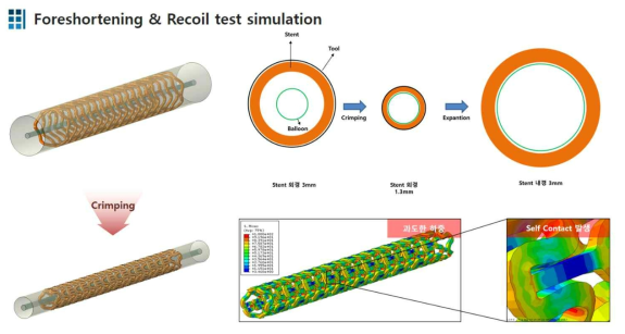 스텐트 리코일 시뮬레이션